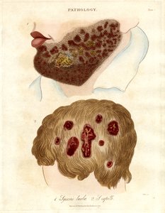 Patologisk illustrasjon av Sycosis barbae og Sycosis capilli av John Pass