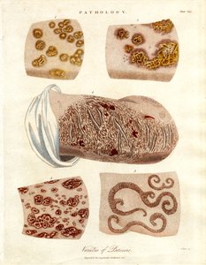 Patologiske hudforandringer: Varianter av psoriasis av John Pass