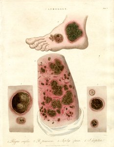 Patologiske hudsykdommer - Pityria, impetigo og syfilis