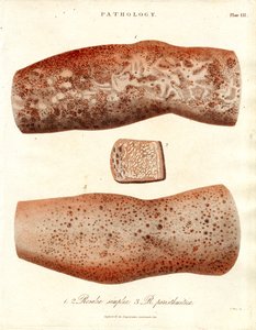 Hudutslett - Roseola simplex og Roseola paristhmitica