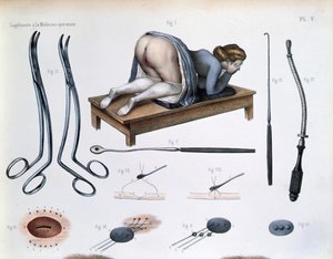 En operasjon på en vesikovaginal fistel, plate fra 