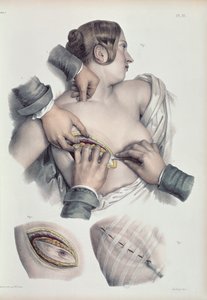 Opererer på en kreftsvulst, fra 
