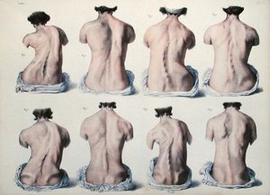 Spinal deformiteter, plate fra 