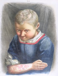 Favus, fra en bok av Daniel Cornelius Danielssen (1815-94) 1892 av Norwegian School