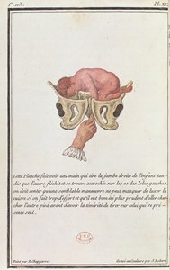 Tverrsnittsdiagram av en baby trukket fra livmoren av armen, fra en bok av Madame Angelique Le Boursier du Coudray (1714-94) gravert av J. Robert, 1783 av P. Chapparre