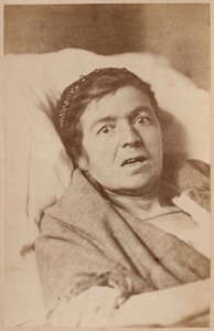 Hysterisk epilepsi, ansiktskontraksjon, plate VIII fra 'Iconographie Photographique de La Salpetriere' av Bourneville og P. Regnard, Paris, 1876 (albumtrykk)
