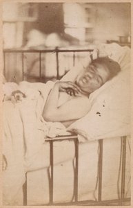 Hysterisk epilepsi, permanent sammentrekning, plate XXVIII fra 