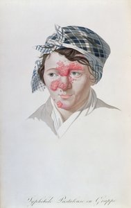 Syfiliske klyngepustler, fra en bok av Baron Jean Louis Alibert (1768-1837) 1838