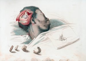 Visning av sår i hodeskallen etter trephination og fjerning av knust benstykke nederst til venstre, 1821 av Thomas Landseer