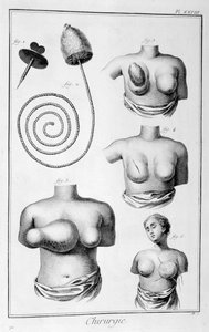 Brystkirurgi, 1751-1777 av Unbekannt