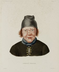 Sykdommer, spedalskhet Spedalsk kvinne, Island, tidlig på 1800-tallet av Unbekannt