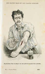 Male et sår med en antiseptisk løsning, c1890 av Unbekannt