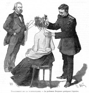 Professor Bergmann injiserer en tuberkulosepasient, 1891 av Unbekannt