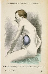 Typisk forstørret milt hos en malariapasient, c1890 av Unbekannt