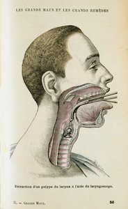 Bruke et laryngoskop for å hjelpe til med å fjerne en polypp fra halsen, c1890 av Unbekannt