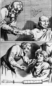 Blutung und Nasendusche von Johannes Sculpteti „Armamentarium Surgery“ Amsterdam 1672 von Unknown artist