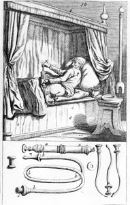 Clystère (for klyster) av Johannes Sculptetus "" Armamentarium Surgical"". Venezia 1665 av Unknown artist