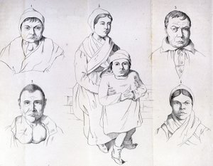 Betraktninger om årsakene til endemisk kretinisme av Morel. av Unknown artist