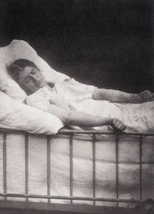 Hystero Epilepsie - Stivkrampeangrep i "" Fotografisk ikonografi av Salpétrière: service of Mr. Charcot"" av Paul Regnard og Bourneville av Unknown artist