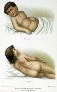 Skarlagensfeber og meslinger - 1800-tallet av Unknown artist