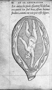 Fosterets posisjon i livmoren under graviditet. Gravering fra "" De la generation des enfants"" av den franske legen og kirurgen Ambroise Pare (1509-1590) 1500-tallet av Unknown artist
