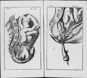 Fødsel av en baby med bruk av tang Plate fra "An abridgement of the practice of midwifery"" av William Smellie (1697-1763) av Unknown artist
