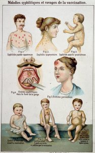 Plate som illustrerer de forskjellige sovesalene til syfilittiske sykdommer og farene ved vaksinasjon - i Bilz naturmedisin, sent på 1800-tallet. av Unknown artist