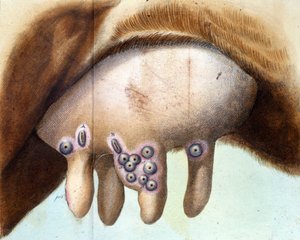 Kuens bryst ble brukt til å inokulere koppevaksinen av Luigi Sacco (1769-1836) i januar 1801. Medisinsk plate fra "" Vaccination Treat" av Luigi Sacco, Milano av Unknown artist
