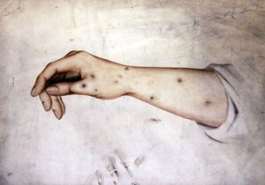 Studie av en underarm med hudtilstand, ca. 1850 (akvarell på papir) av William Lover