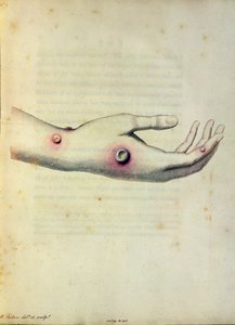 Cowpox pustle på armen til Sarah Nelmes, fra 