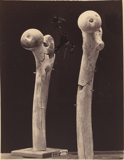 Prøver av skuddbrudd i lårbeinet av American 19th Century