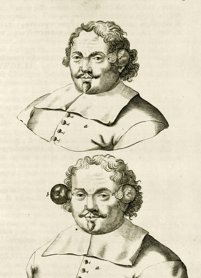 Et eksempel på kopping, fra The Practice of Medicine av Frederik Dekkers, 1694 av Dutch School