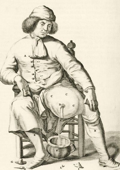 Drenering av væske fra en abscess av Frederik Dekkers, 1694 av Dutch School