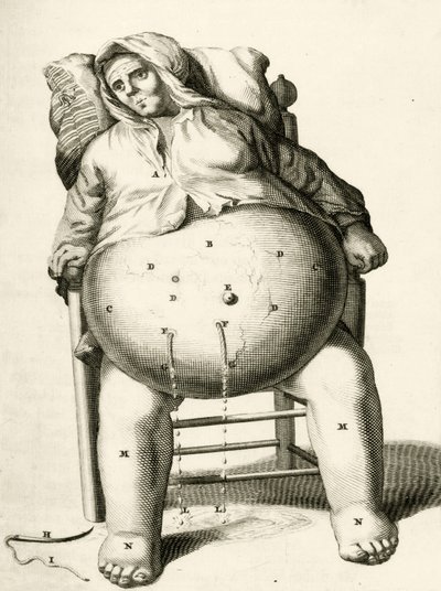Drenering av væsker fra en abscess av Frederik Dekkers, 1694 av Dutch School