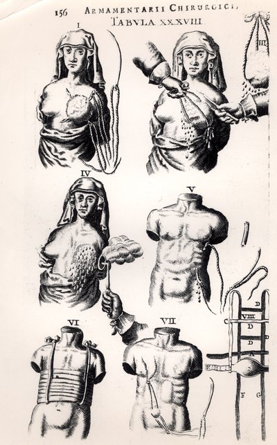 Opererer på brystkreft, fra Armamentarii Chirurgici av Johannes Schultes (1595-1645) utgitt i Amsterdam, 1672 av Dutch School