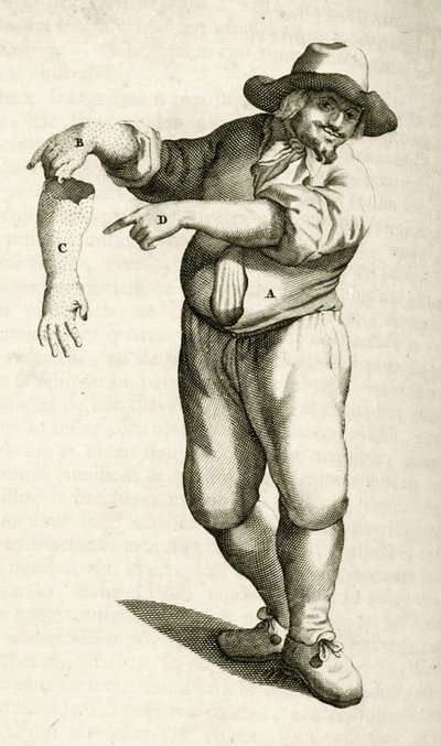 Fjerning av død hud med pustler, fra Practical Exercises in Medical Methods av Frederik Dekkers, 1694 av Dutch School