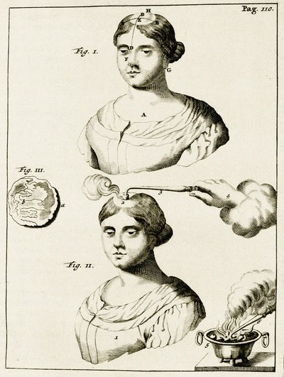 Behandling av en lider av epilepsi, fra Exercises in the Practice of Medicine av Frederik Dekkers, 1694 av Dutch School