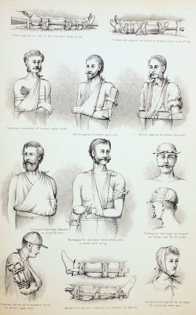 Midlertidig behandling av brudd, ca. 1890 av English School
