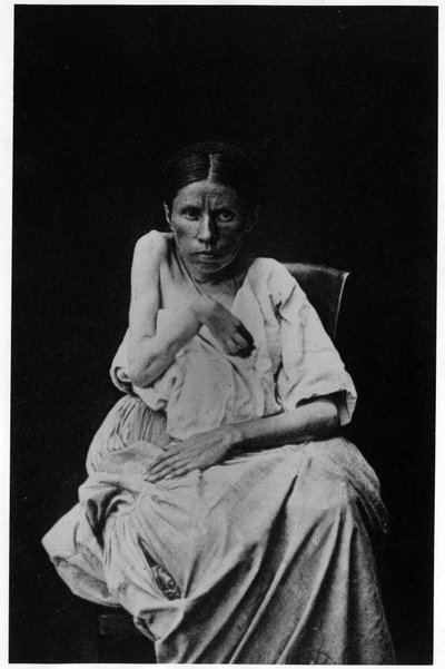Fotografi av en pasient som lider av hemiplegisk epilepsi, -i "" fotografisk ikonografi av Salpetrière, Bourneville og P. Regnard, Paris av French Photographer
