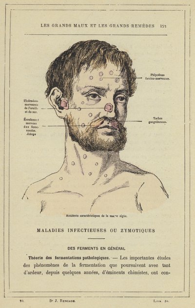 Karakteristiske strøk av akutt snørr (farge litho) av French School