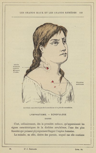 Karakteristiske ulykker av skrofulose i sekundærperioden (farge litho) av French School