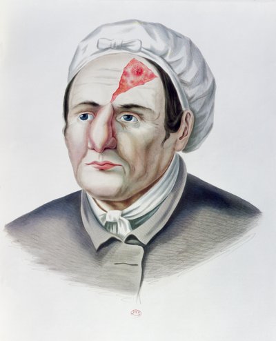 Etter en hudtransplantasjonsoperasjon, fra Selecta Praxis Medico-Chirurgica av Alexander Auvert, Paris, 1856 av French School