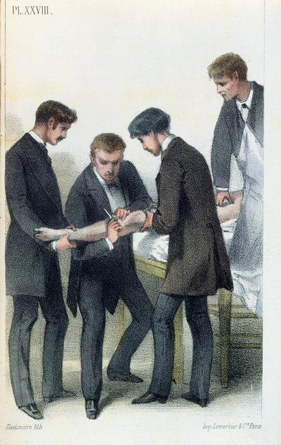 Amputere en arm, fra en medisinsk manual av Jean-Baptiste-Leon Dubreuil, ca. 1850-60 av French School
