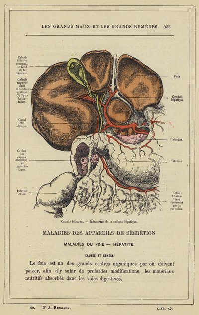 Gallestein, mekanisme for hepatisk kolikk (farge litho) av French School