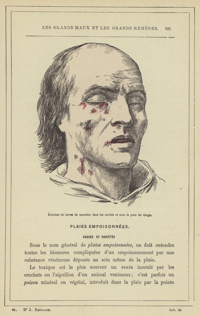 Klekking av fluelarver i hulrommene og under huden i ansiktet (farge litho) av French School