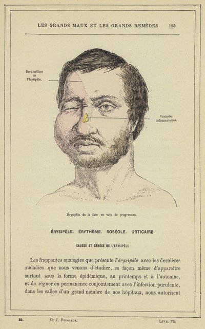 Progressiv ansikts erysipelas (farge litho) av French School