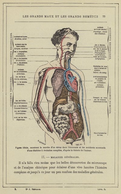 Ideell figur, som viser fremgangen til et virus i økonomien og de påfølgende ulykkene til en diatese med fullstendig evolusjon, i henhold til forfatterens teori (farge litho) av French School