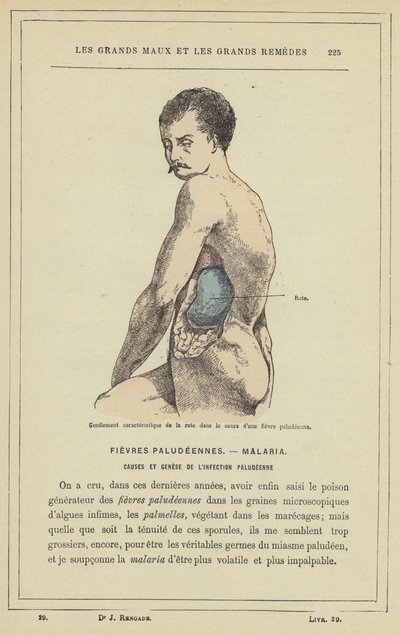 Karakteristisk hevelse i milten i løpet av malariafeber (farge litho) av French School