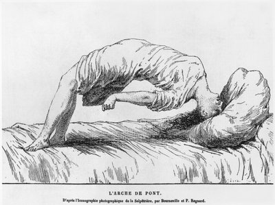 Hysteri og somnambulisme, fra Les Maladies Endemiques de l