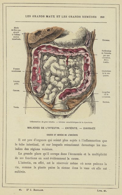 Betennelse i tykktarmen, lesjoner som er karakteristiske for dysenteri (farge litho) av French School